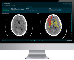 Brainomix 360 e-ASPECTS stroke AI imaging platform